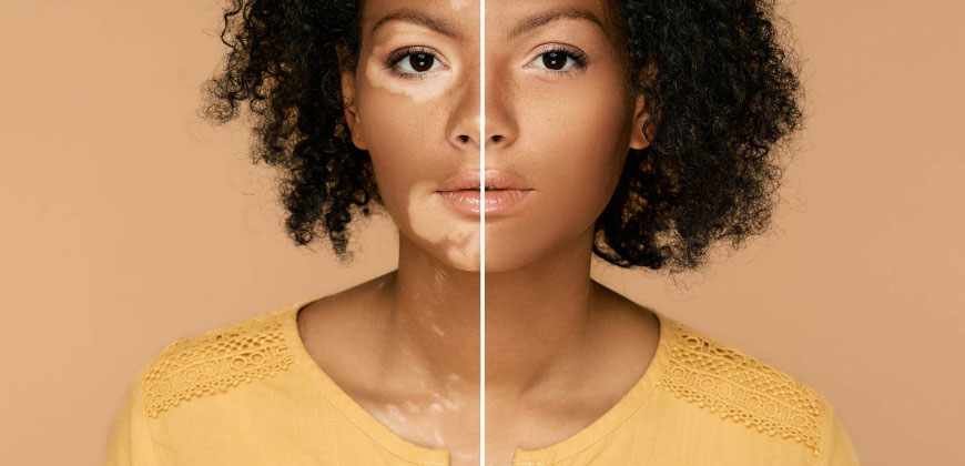 vitiligo